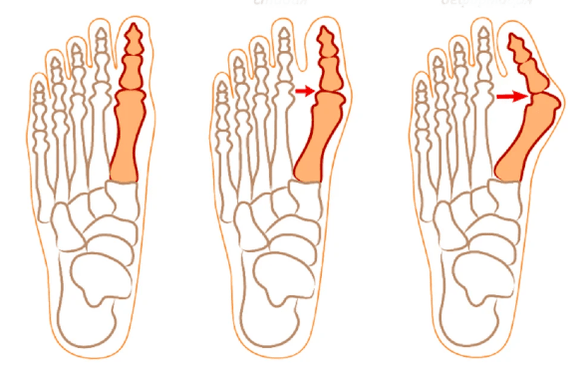 Hallux valgus deformáció