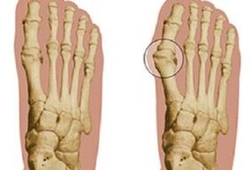 hallux valgus okai
