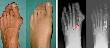 hallux valgus tünetei