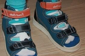 hallux valgus szandál viselése gyermeknél