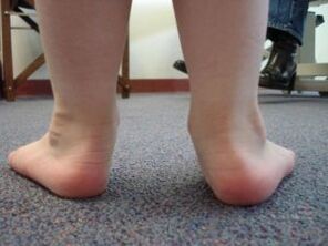 Lapos valgus lábdeformitás gyermeknél