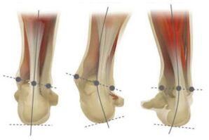 Normál láb, a calcaneus valgus és varus eltérésével