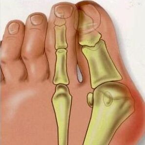 A valgus okai