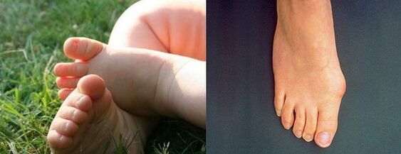 A láb első ujjának valgus deformációja