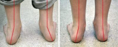 Valgus görbület